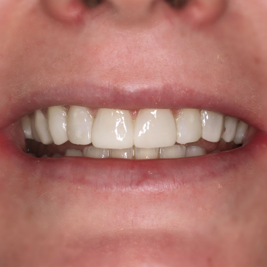 edge bonding - after- teeth sensitivity - 3Dental